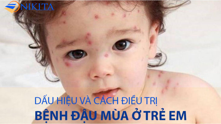 bệnh đậu mùa