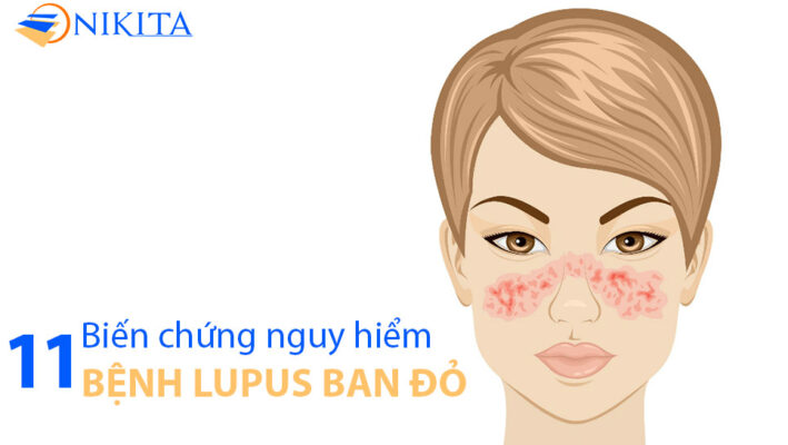bệnh lupus ban đỏ