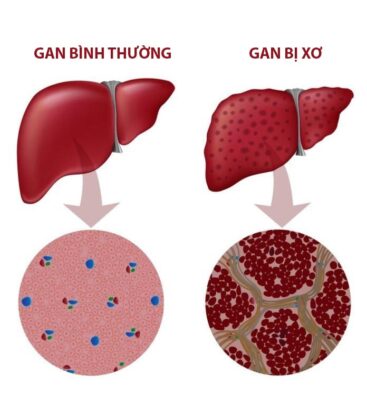 Tìm hiểu về bệnh xơ gan là gì